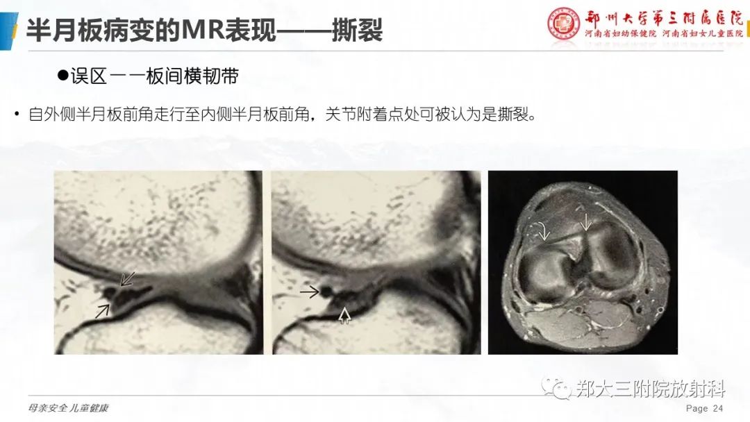 影像PPT - 【PPT】膝关节半月板病变的影像学表现-24