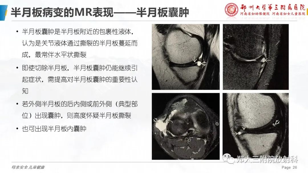 影像PPT - 【PPT】膝关节半月板病变的影像学表现-26