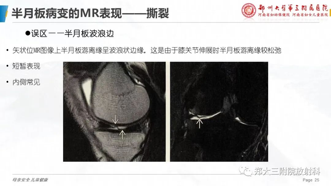 影像PPT - 【PPT】膝关节半月板病变的影像学表现-25