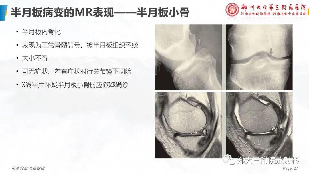 影像PPT - 【PPT】膝关节半月板病变的影像学表现-27