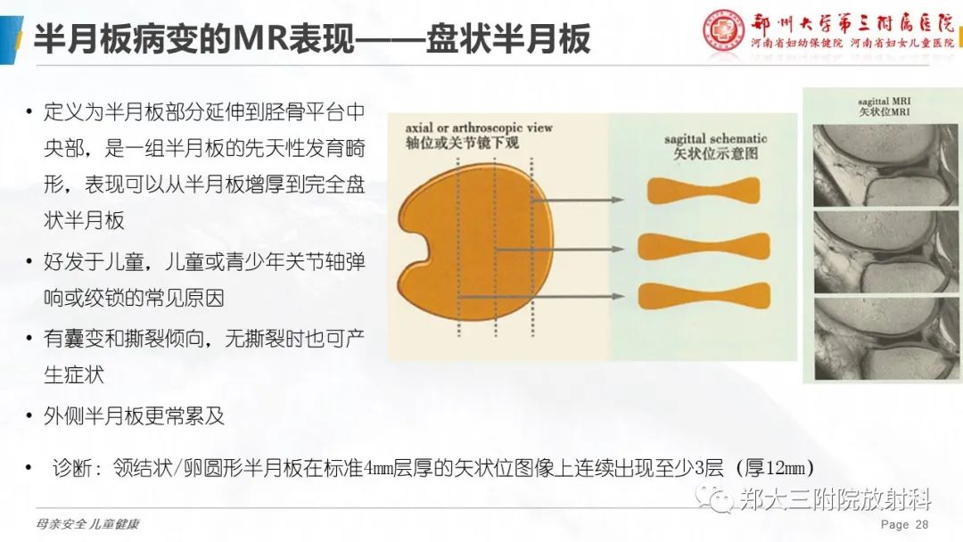 影像PPT - 【PPT】膝关节半月板病变的影像学表现-28