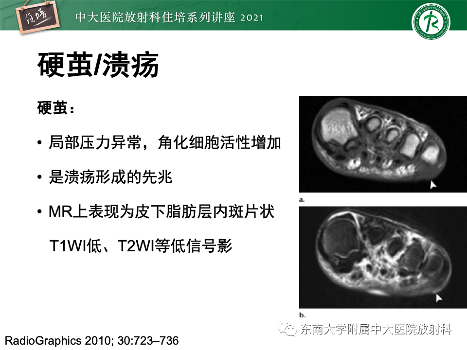 影像PPT - 【PPT】糖尿病足影像学评估-7