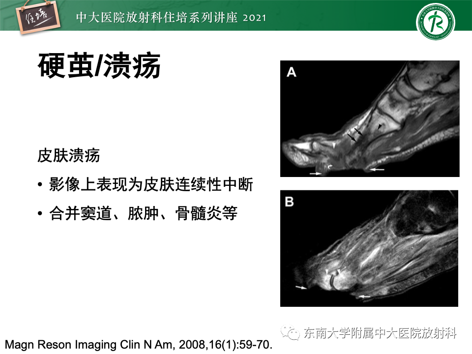 影像PPT - 【PPT】糖尿病足影像学评估-8