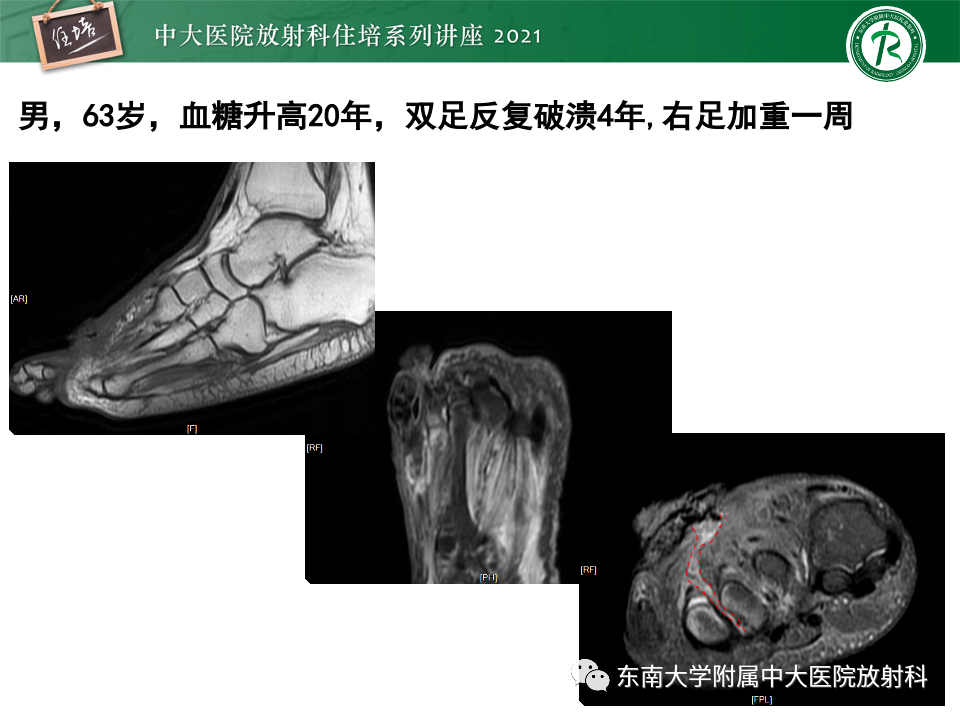 影像PPT - 【PPT】糖尿病足影像学评估-10
