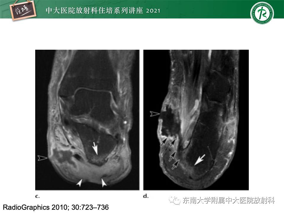 影像PPT - 【PPT】糖尿病足影像学评估-11