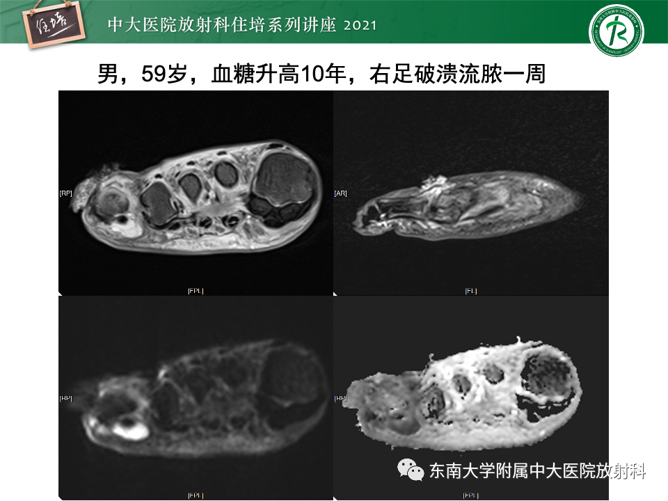 影像PPT - 【PPT】糖尿病足影像学评估-13