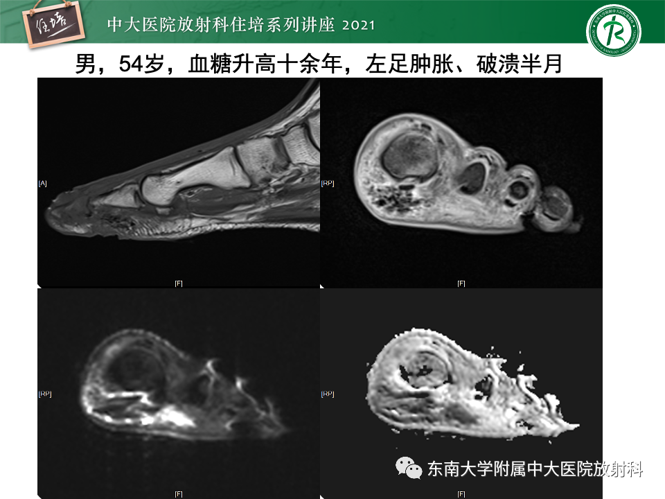 影像PPT - 【PPT】糖尿病足影像学评估-14