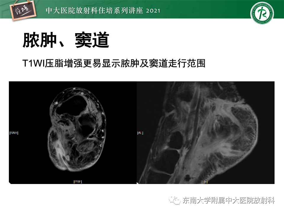 影像PPT - 【PPT】糖尿病足影像学评估-15