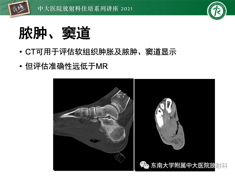 影像PPT - 【PPT】糖尿病足影像学评估-16