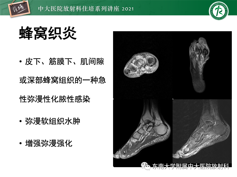 影像PPT - 【PPT】糖尿病足影像学评估-17