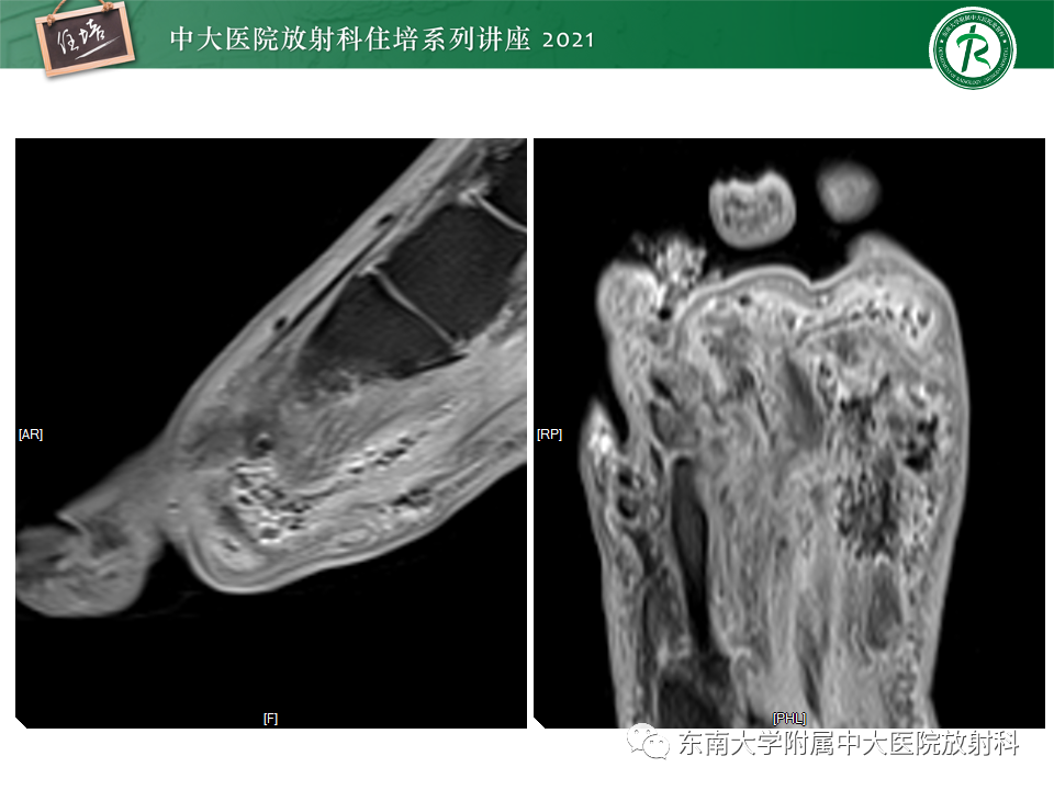 影像PPT - 【PPT】糖尿病足影像学评估-19