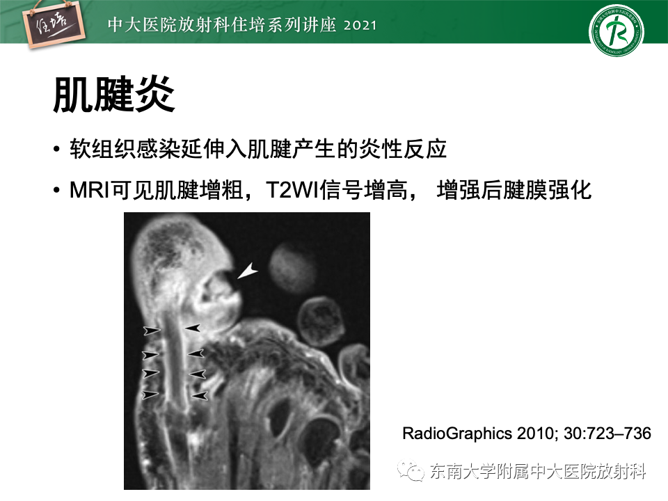影像PPT - 【PPT】糖尿病足影像学评估-21