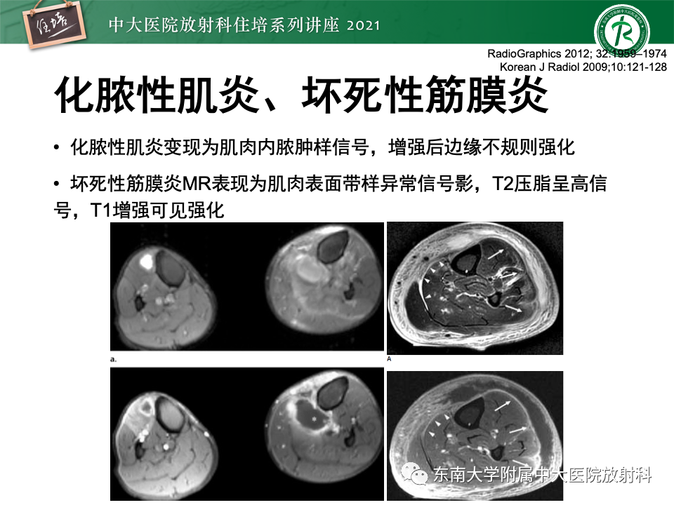 影像PPT - 【PPT】糖尿病足影像学评估-22
