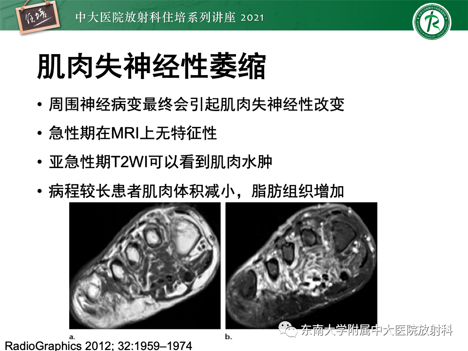 影像PPT - 【PPT】糖尿病足影像学评估-23