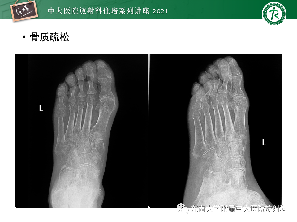 影像PPT - 【PPT】糖尿病足影像学评估-25