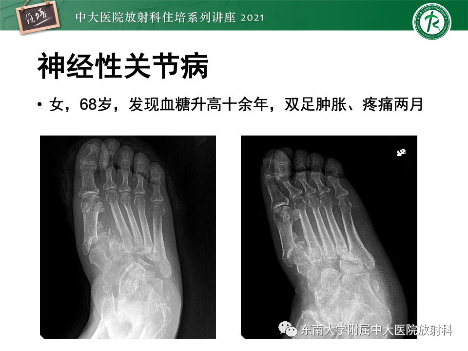 影像PPT - 【PPT】糖尿病足影像学评估-27