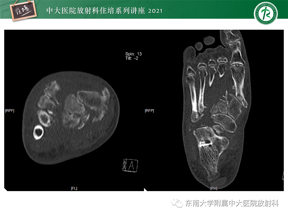 影像PPT - 【PPT】糖尿病足影像学评估-28