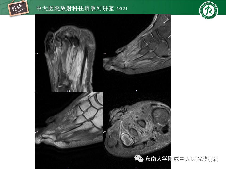 影像PPT - 【PPT】糖尿病足影像学评估-30