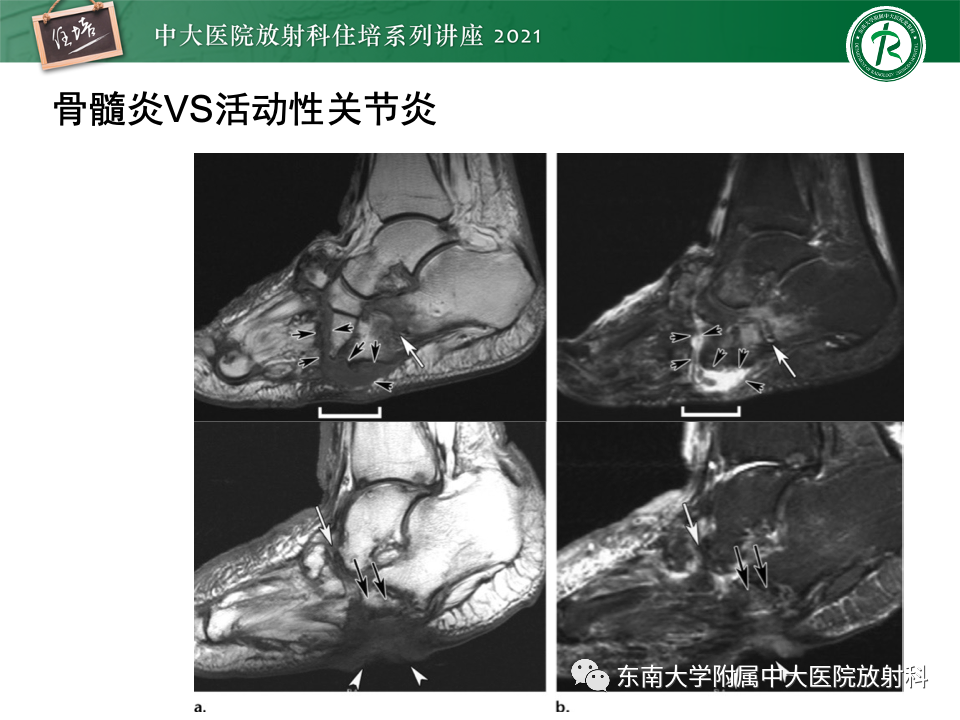 影像PPT - 【PPT】糖尿病足影像学评估-31