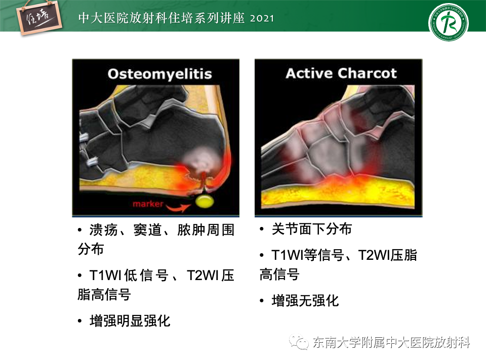影像PPT - 【PPT】糖尿病足影像学评估-32