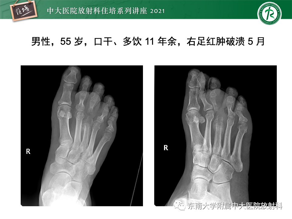 影像PPT - 【PPT】糖尿病足影像学评估-34