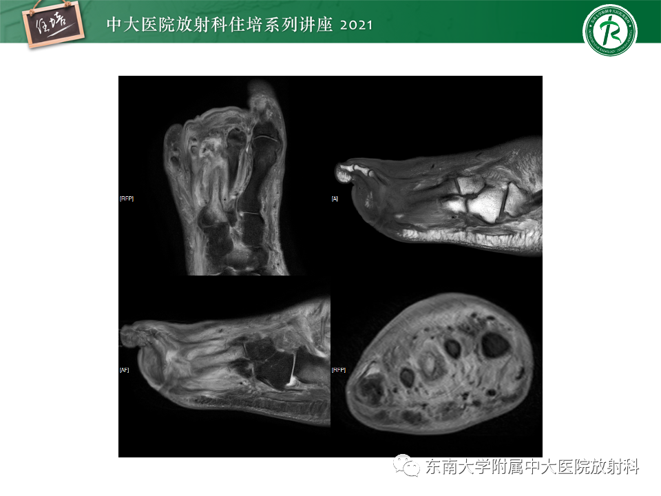 影像PPT - 【PPT】糖尿病足影像学评估-35