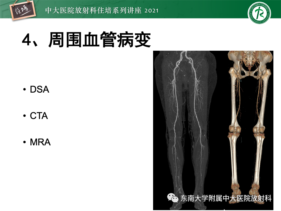 影像PPT - 【PPT】糖尿病足影像学评估-36