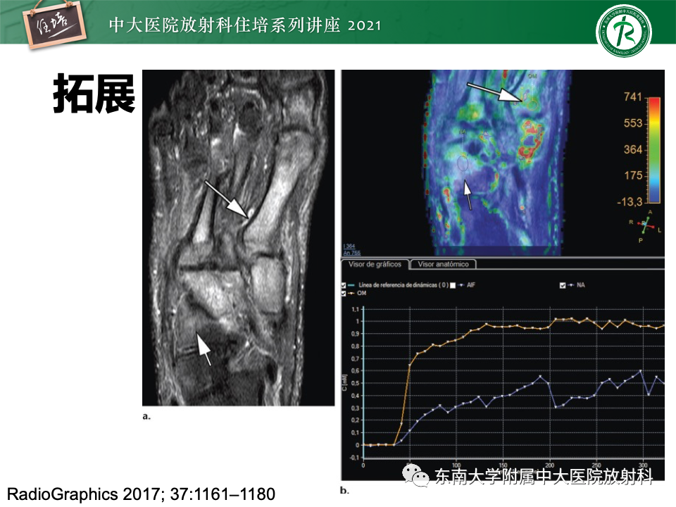 影像PPT - 【PPT】糖尿病足影像学评估-40