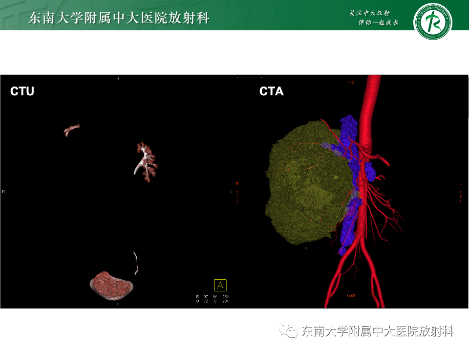 影像PPT - 【PPT】肾母细胞瘤-8