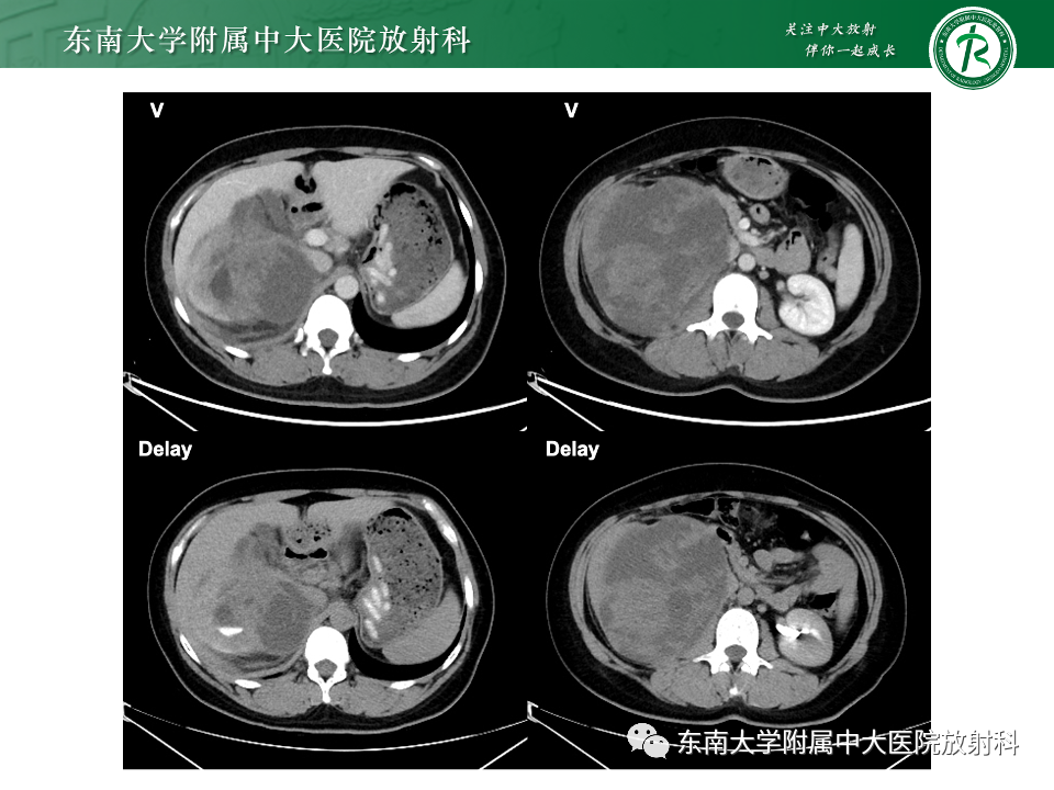 影像PPT - 【PPT】肾母细胞瘤-7