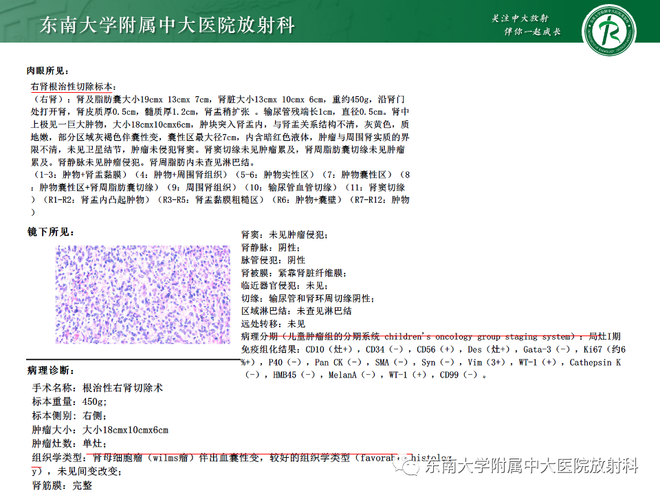 影像PPT - 【PPT】肾母细胞瘤-10