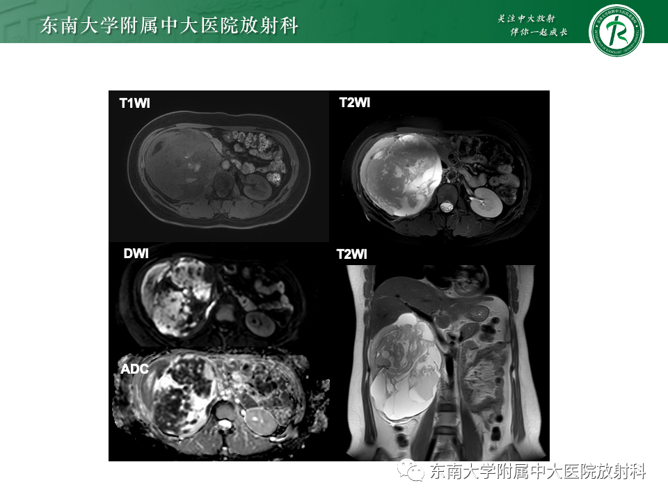 影像PPT - 【PPT】肾母细胞瘤-9