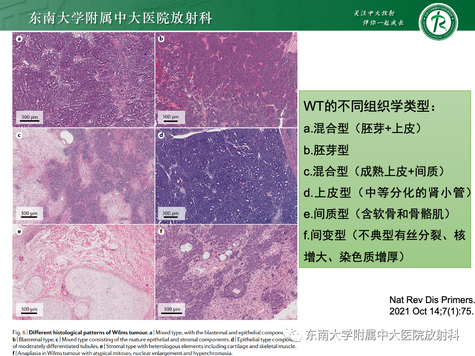 影像PPT - 【PPT】肾母细胞瘤-20