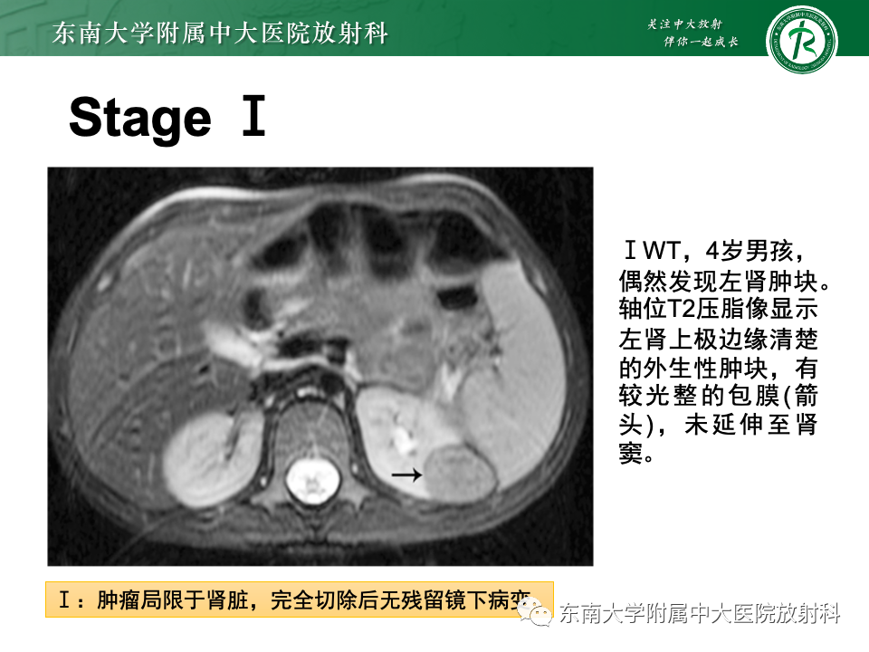 影像PPT - 【PPT】肾母细胞瘤-27