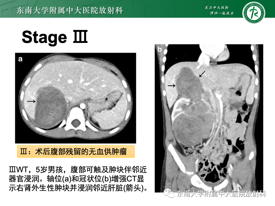影像PPT - 【PPT】肾母细胞瘤-29
