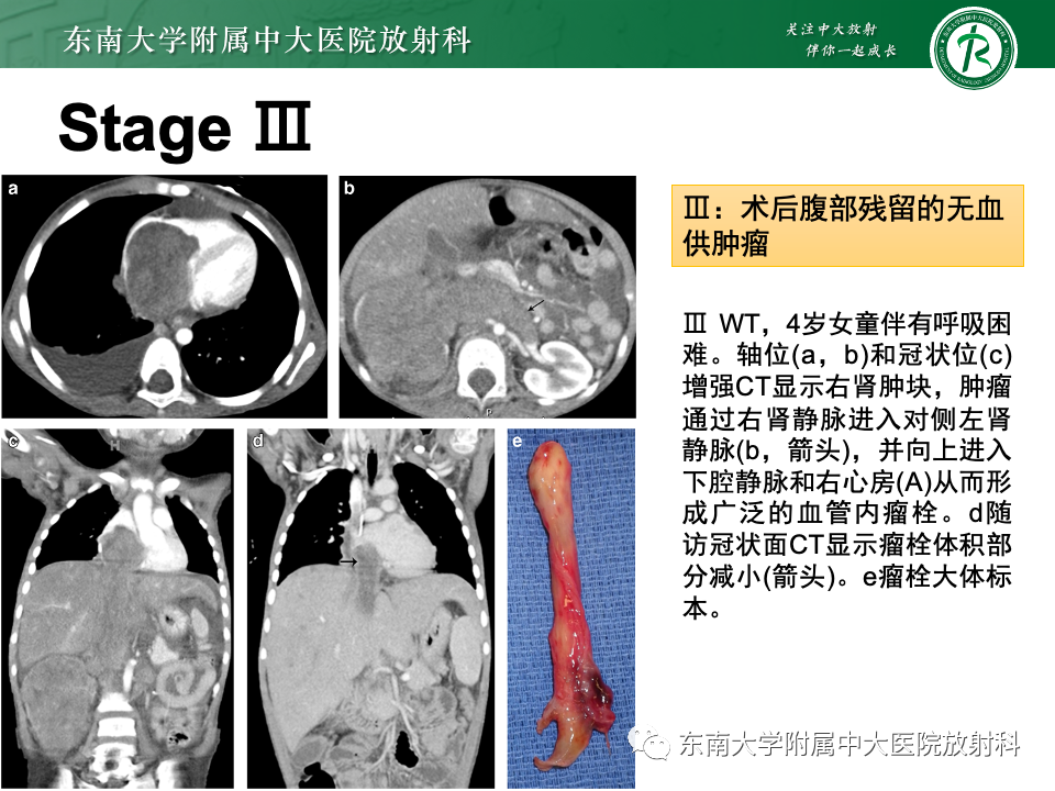 影像PPT - 【PPT】肾母细胞瘤-30