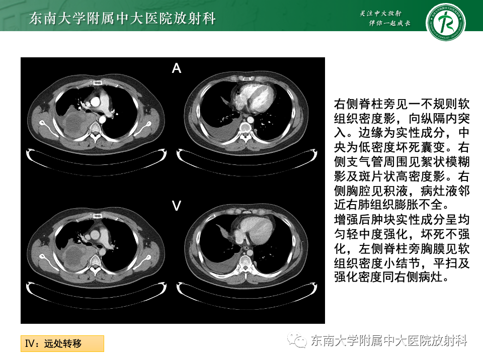 影像PPT - 【PPT】肾母细胞瘤-32