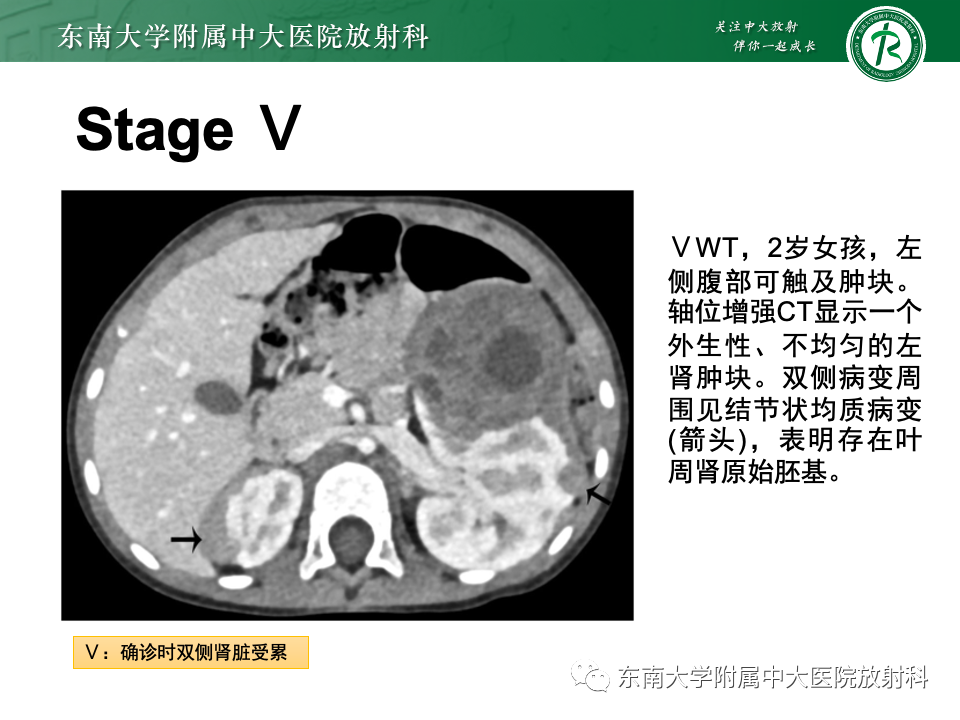 影像PPT - 【PPT】肾母细胞瘤-33