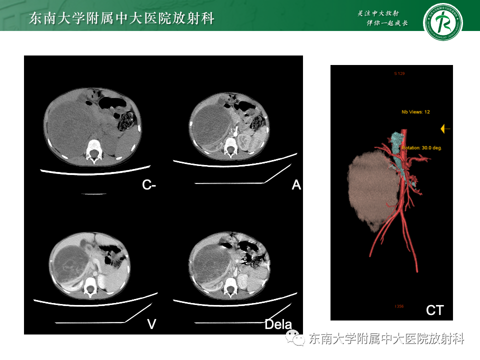 影像PPT - 【PPT】肾母细胞瘤-35