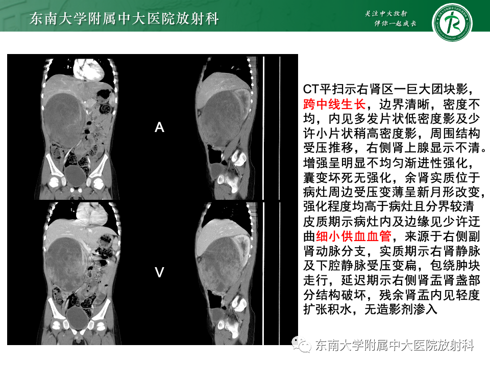 影像PPT - 【PPT】肾母细胞瘤-36