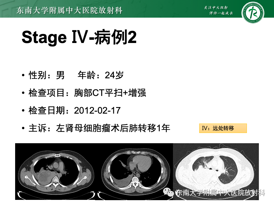 影像PPT - 【PPT】肾母细胞瘤-31