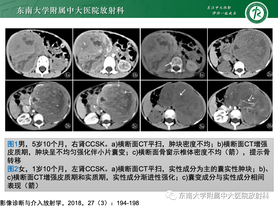影像PPT - 【PPT】肾母细胞瘤-42