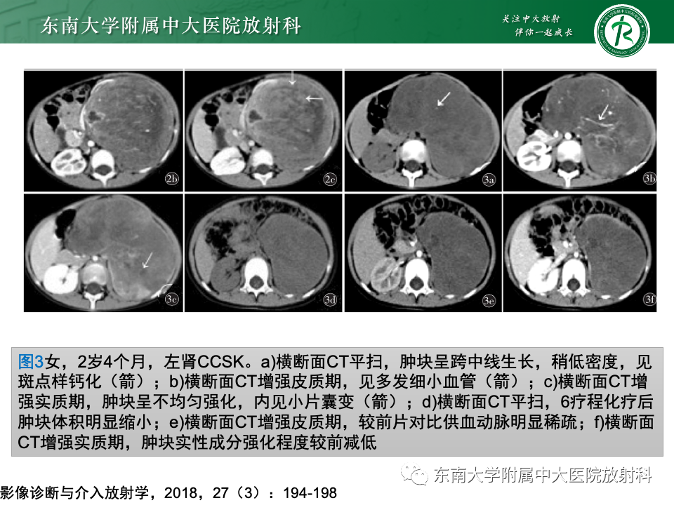 影像PPT - 【PPT】肾母细胞瘤-43