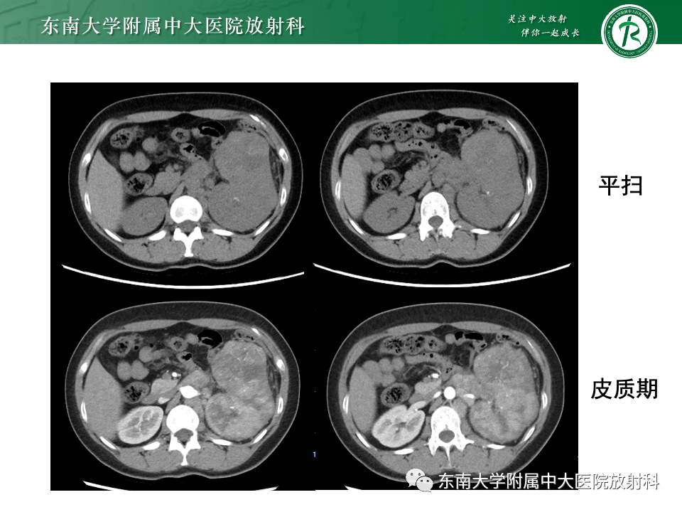 影像PPT - 【PPT】肾母细胞瘤-47