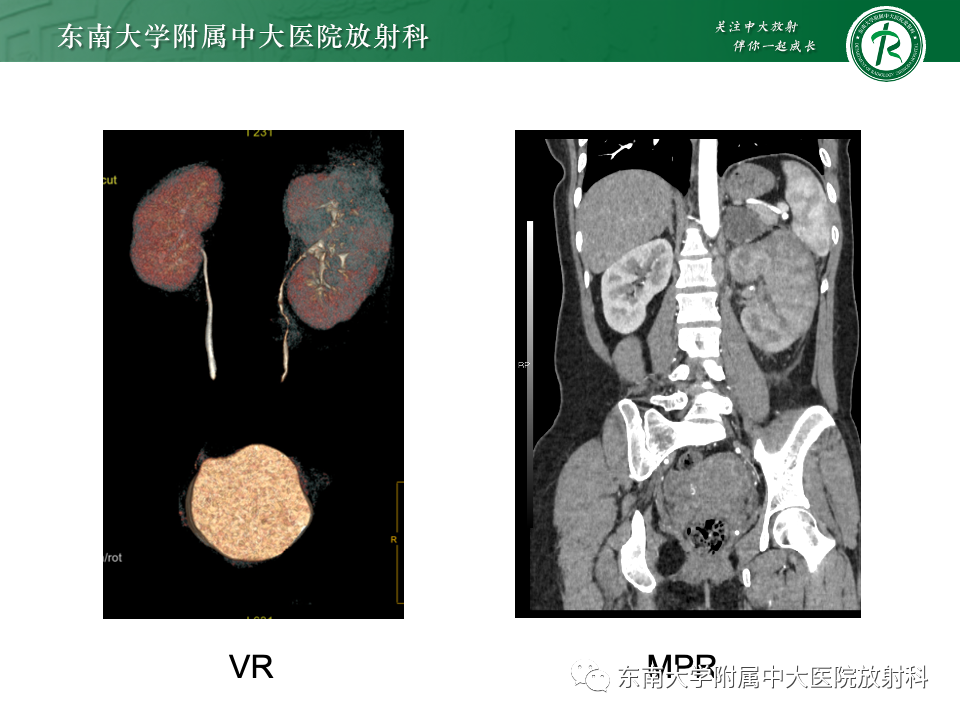 影像PPT - 【PPT】肾母细胞瘤-49