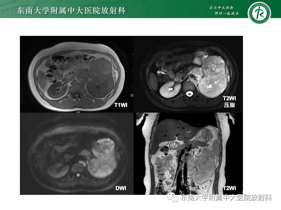 影像PPT - 【PPT】肾母细胞瘤-50