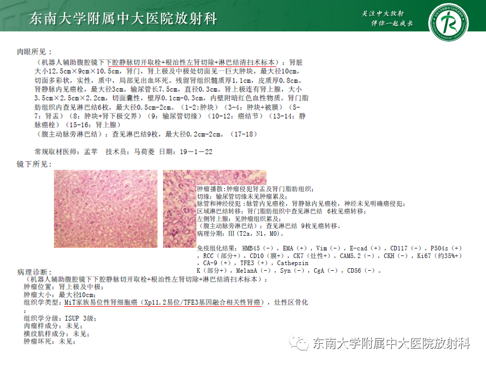影像PPT - 【PPT】肾母细胞瘤-51