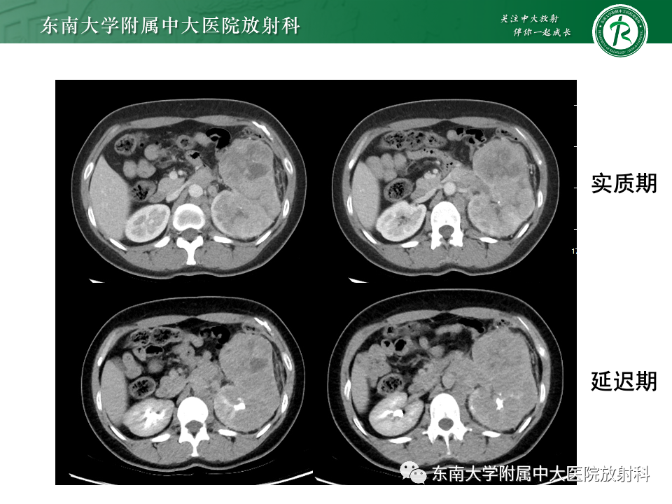 影像PPT - 【PPT】肾母细胞瘤-48