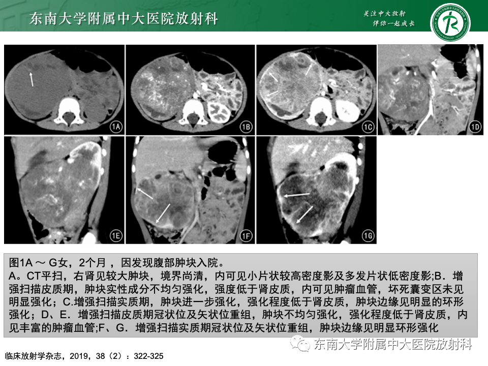 影像PPT - 【PPT】肾母细胞瘤-55
