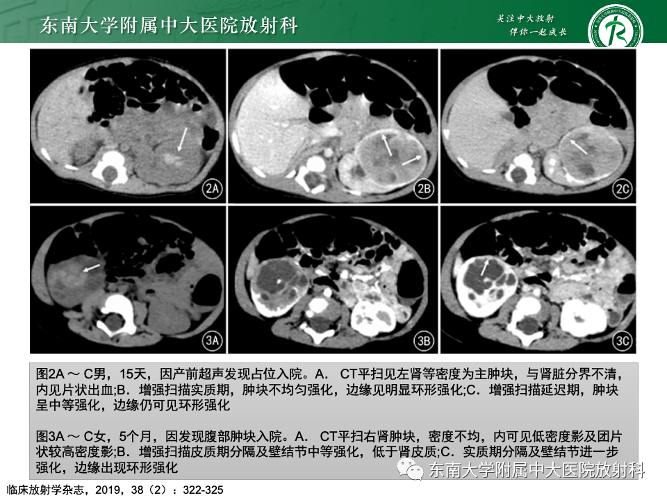 影像PPT - 【PPT】肾母细胞瘤-56